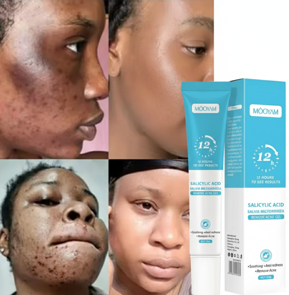 2 boites de Gel anti acné
