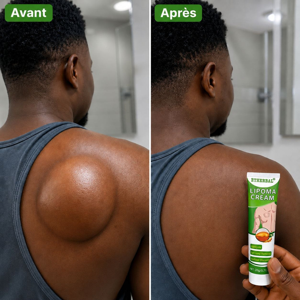 Éliminez vos lipomes et boules de graisse naturellement sans chirurgie 🇳🇪