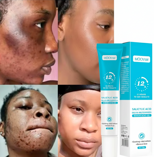 2 boites de Gel anti acné